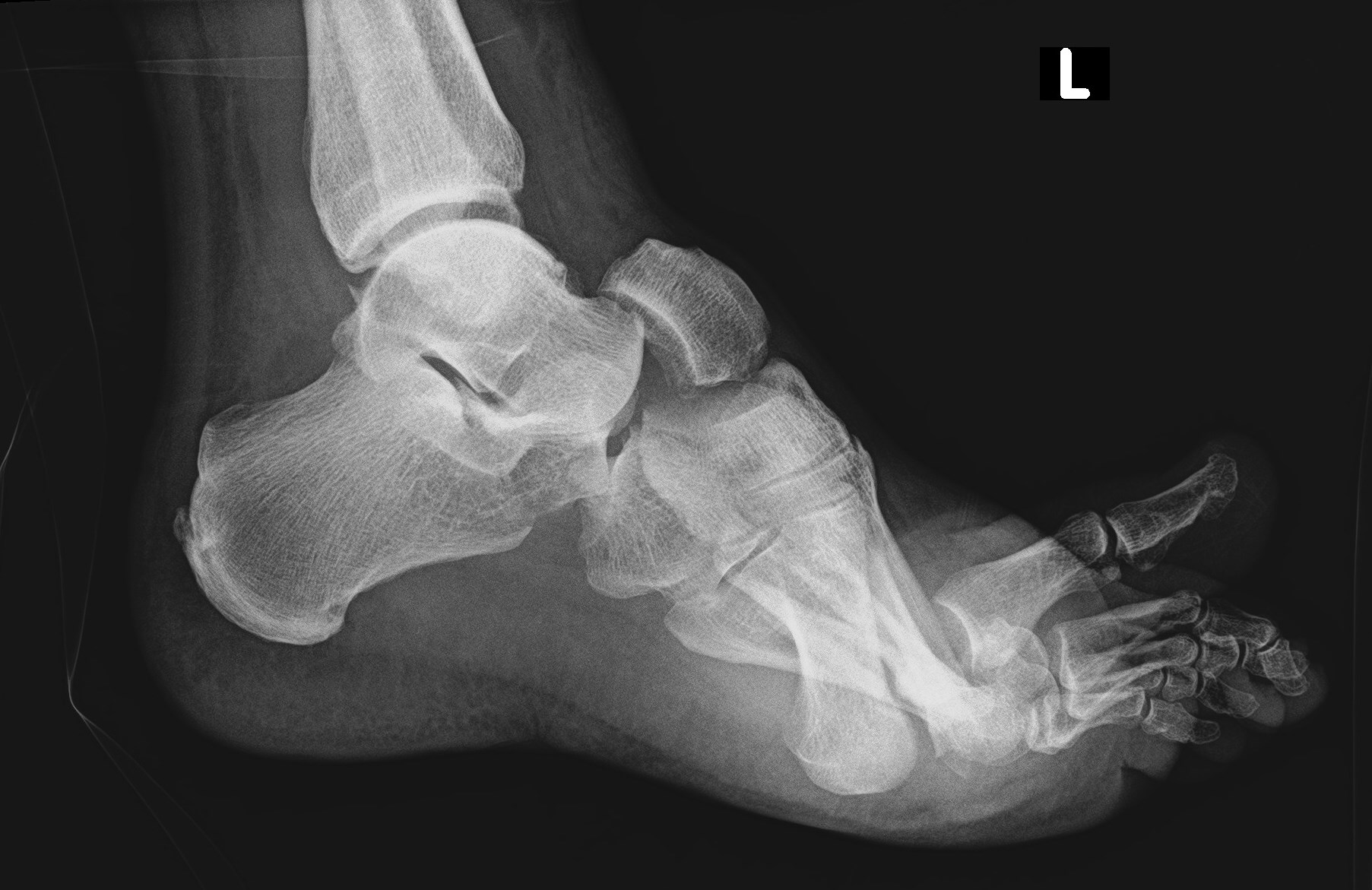 avulsion fracture of navicular bone of right foot icd 10